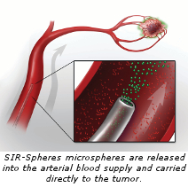 SIR-Spheres microspheres are released into the arterial blood supply and carried directly to the tumor.