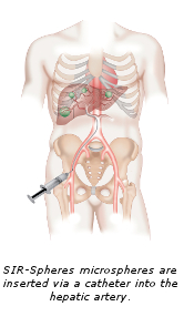 SIR-Spheres microspheres are inserted via a catheter into the hepatic artery.