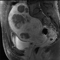 Uterine fibroid tumors can cause Heavy menstrual pain. Call Memphis clinic for help.