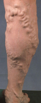 varicose veins memphis